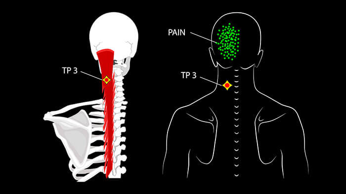Semispinalis Trigger Points and Muscle Pain