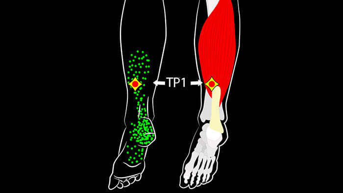 Soleus Trigger Points and Muscle Pain