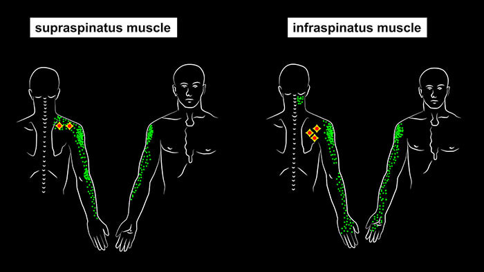 Supraspinatus and infraspinatusTrigger Points