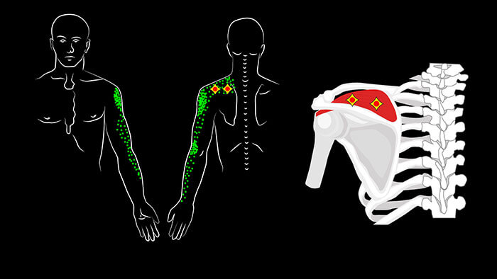 Supraspinatus Trigger Points