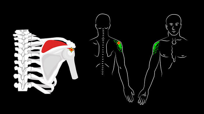 Trigger Points of the Supraspinatus muscle