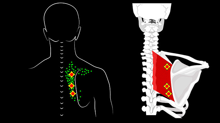 Rhomboid Major trigger points