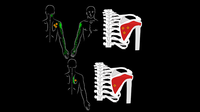 Trigger points of the infraspinatus muscle